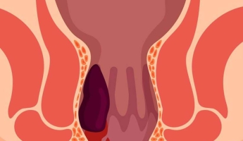 Tuvalette Telefon Kullanımı Hemoroid Riskini Artırabilir